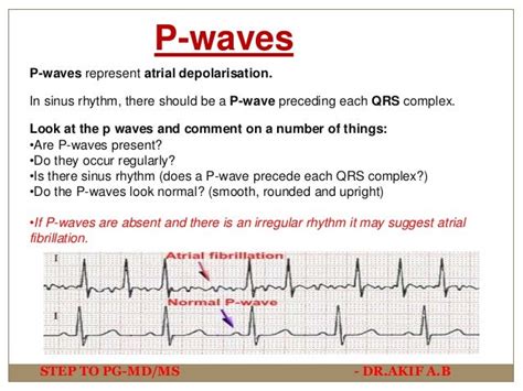 Ecg