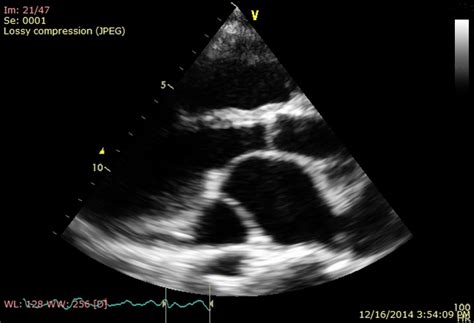 Persistent Left Superior Vena Cava In Atrial Septal Defect Sinus