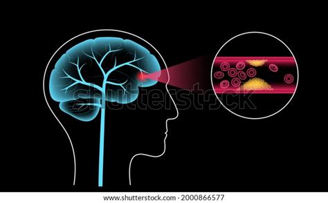 Ischemic Brain Stroke Arteriosclerosis Infarct Tia Stock Vector