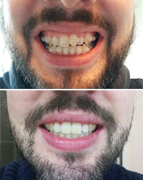 Before After Braces Wazio Orthodontics 50 OFF