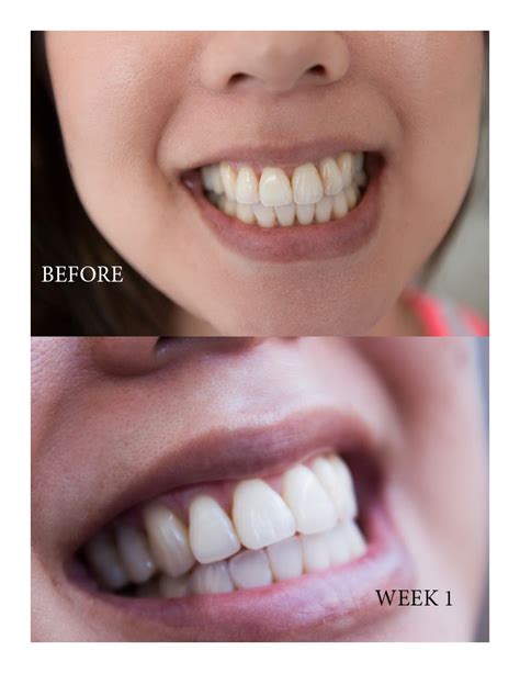 Dress Yourself Happy By Serein: Get Your Whitest Teeth EVER!