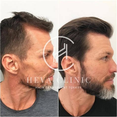 34 3000 Hair Grafts Before And After RameezZakeer