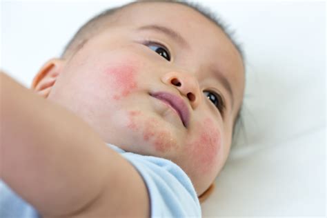 How to naturally ease baby’s eczema