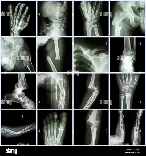 Broken Bones X-Rays | lupon.gov.ph