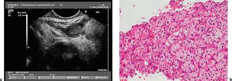 Eus Guided Biopsy—indications Problems Pitfalls Troubleshooting And