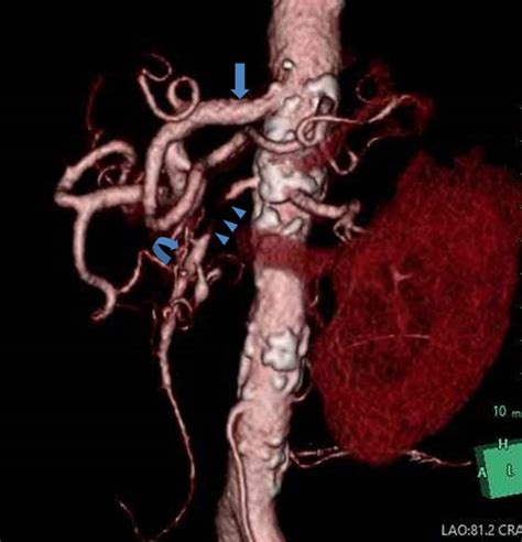 3d Reconstruction Of Ct Angiogram Left Anterior Oblique View Showing