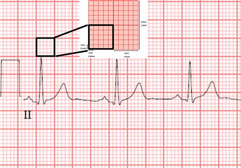 Bundle Branch Block - Causes, Symptoms, Diagnosis, Treatment