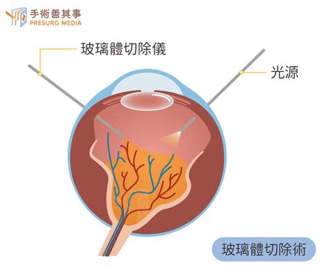 不痛不癢卻會瞎 沈默的視網膜剝離