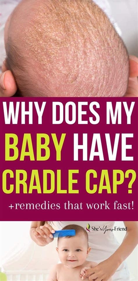 Complete Guide To Cradle Cap And Baby Artofit