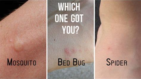 Bed Bug Rash Pictures Medical Pictures And Images Updated Free