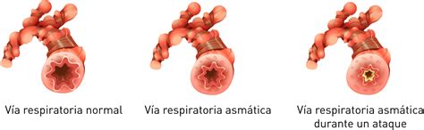 asma