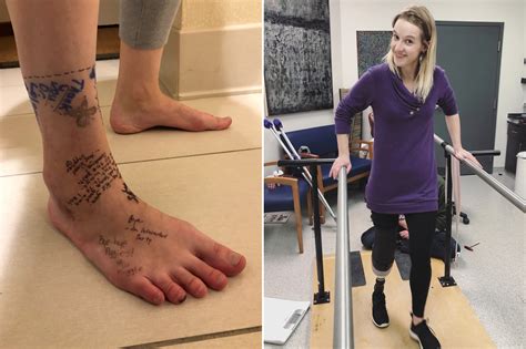 Mason S Journey The Impact Of Leg Amputation Surgery