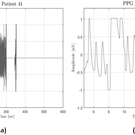 ABP Anomalies Negative BP Followed By Flat Peaks A And No Heartbeat