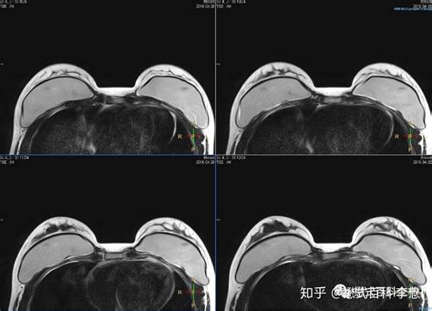 磁共振乳腺扫描规范及全流程技术分享 知乎