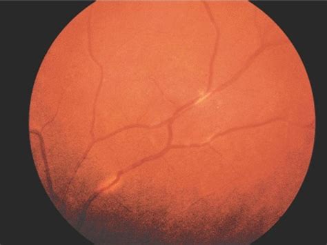 Ocular sarcoidosis more likely in smokers - Optician