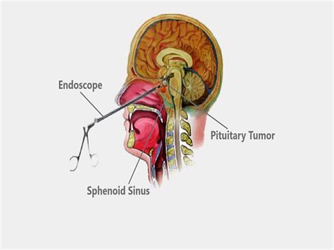 Pituitary Tumor Treatment In India