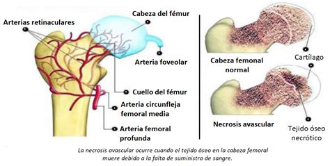 Enfermedad De Perthes FisioOnline