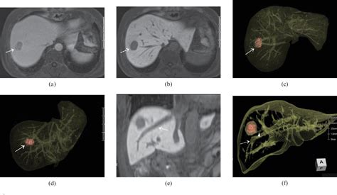 Figure 1 From Three Dimensional Images Of Liver Tumours Reconstructed