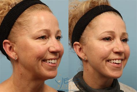 Upper Eyelid Blepharoplasty Before After Photos Patient