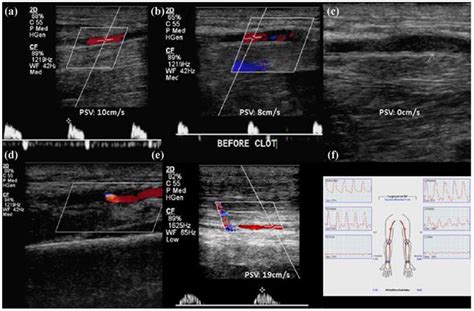 Duplex Ultrasound And Doppler Evaluation Of Radial Artery Preoperative Download Scientific