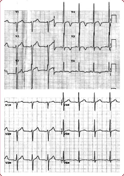 ECG changes acute cardiogenic pulmonary edema with preserved left ...