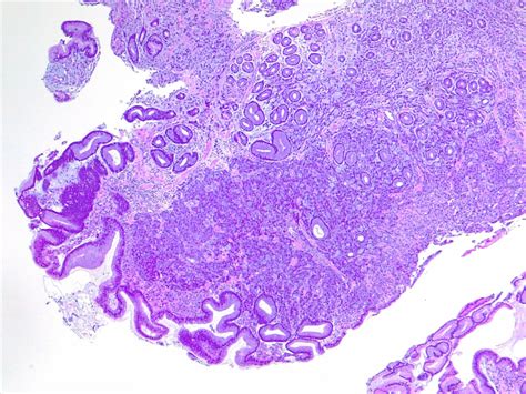 Figure Gastric Carcinoma Signet Ring Type Statpearls Ncbi