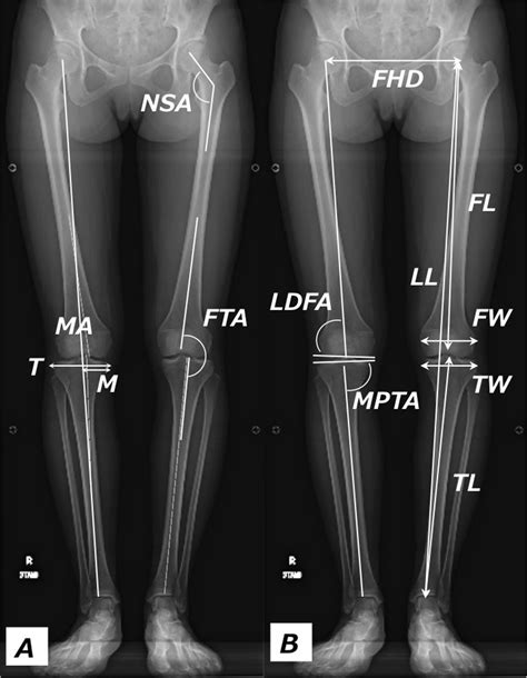 Characterization Of Cartilage Defects Detected By MRI In Kellgren