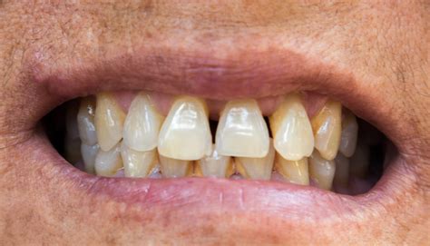 7 Causes Of Black Lines On Teeth And Preventive Methods Icy Health