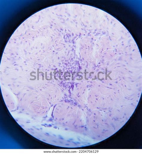 Spindle Cell Melanoma: Over 11 Royalty-Free Licensable Stock Photos | Shutterstock