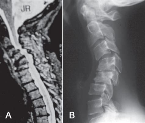 Cervical Kyphosis Musculoskeletal Key