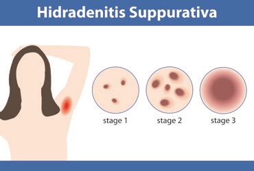 Secukinumab Improves Symptoms of Hidradenitis Suppurativa