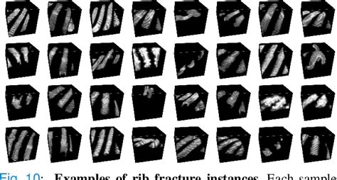 Figure 10 From Deep Rib Fracture Instance Segmentation And