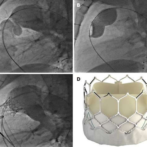 Medtronic Harmony Transcatheter Pulmonic Valve Reproduced With