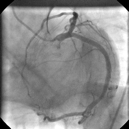 Coronary angiography LAD. | Download Scientific Diagram