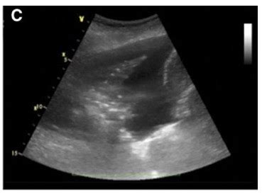 Lung Point Of Care Ultrasound Openanesthesia