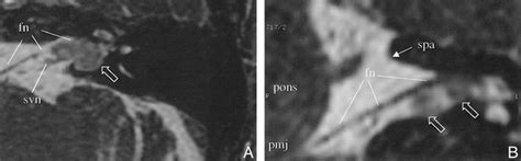 Assessment Of Internal Auditory Canal Tumors A Comparison Of Contrast