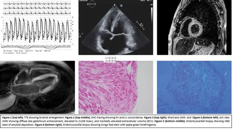 Cardiac Al Amyloid Getting To The Heart Of The Matter Journal Of The