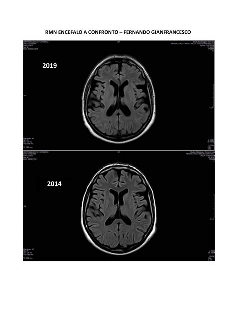 14 04 2023 Effettuato Una RMN Encefalo Di Controllo