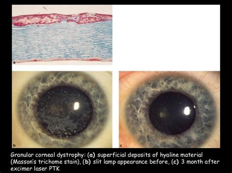 Phototherapeutic keratectomy