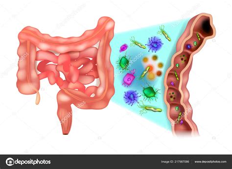 Dysbiosis Also Called Dysbacteriosis Dysbacteriosis Intestine Colon