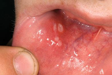 Case study: Recurrent mouth ulcers | GPonline