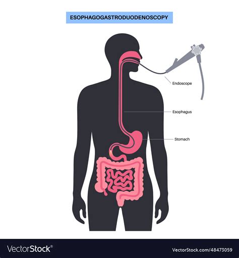 Esophagogastroduodenoscopy medical procedure Vector Image