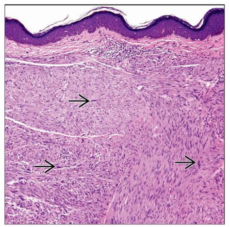 Leiomyosarcoma | Basicmedical Key