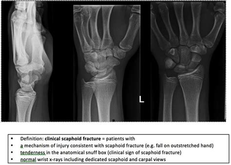 Diagnosis Of Scaphoid Fractures Resus