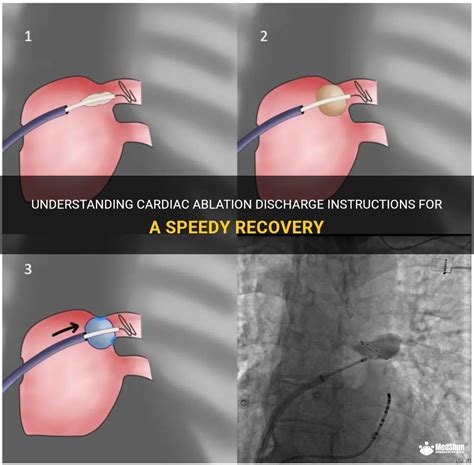 Understanding Cardiac Ablation Discharge Instructions For A Speedy ...