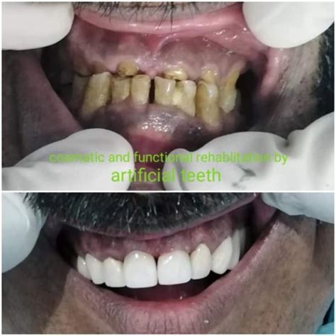 Tooth Surface Loss Management - Odontology Inn