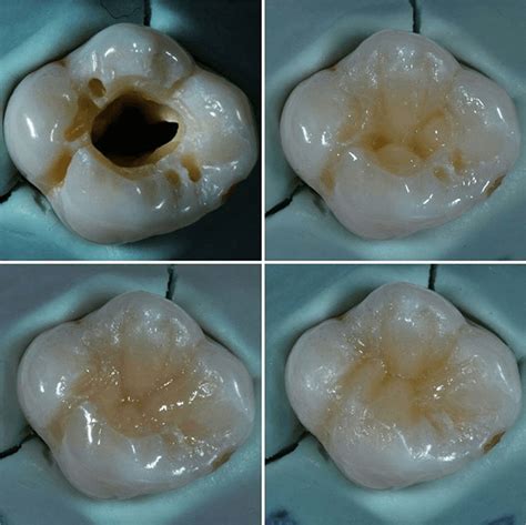 Tooth filling procedure and result