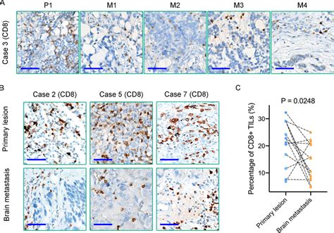 A B Immunohistochemical Staining Reveals The Density Of Cd8 Tils In