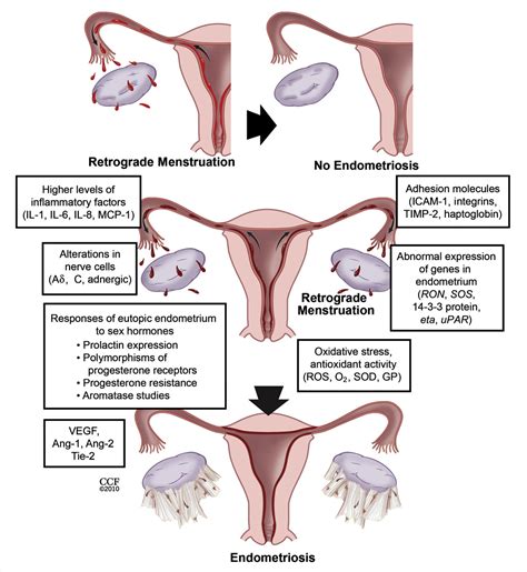 Figure 1 From Role Of Eutopic Endometrium In Pelvic Endometriosis Semantic Scholar