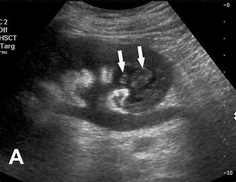 renal papillary necrosis ultrasound - Google Search | Radiology imaging ...